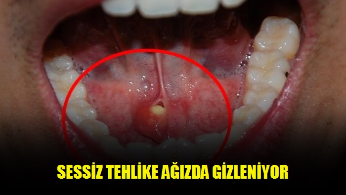 Sessiz tehlike ağızda gizleniyor